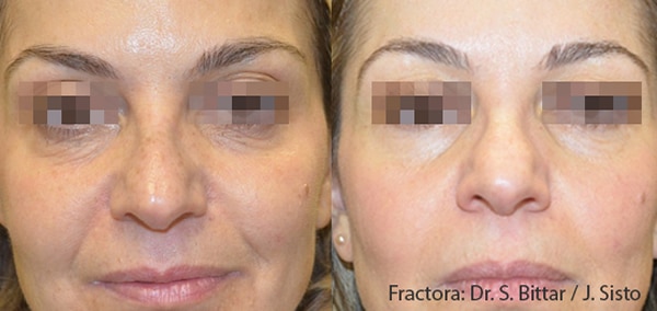 fractora rf treatment for skin tightening before and after