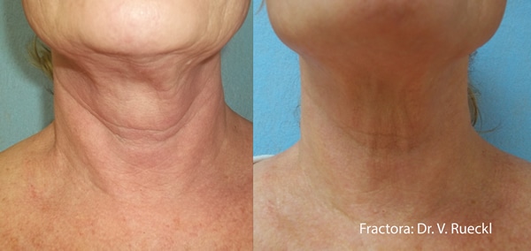 fractora rf treatment for neck bands before and after