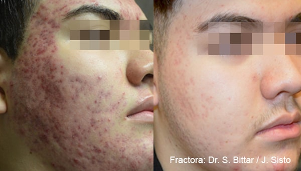 Fractora RF treatment for acne scars before and after