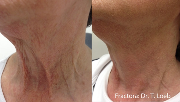 fractora RF treatment before and after