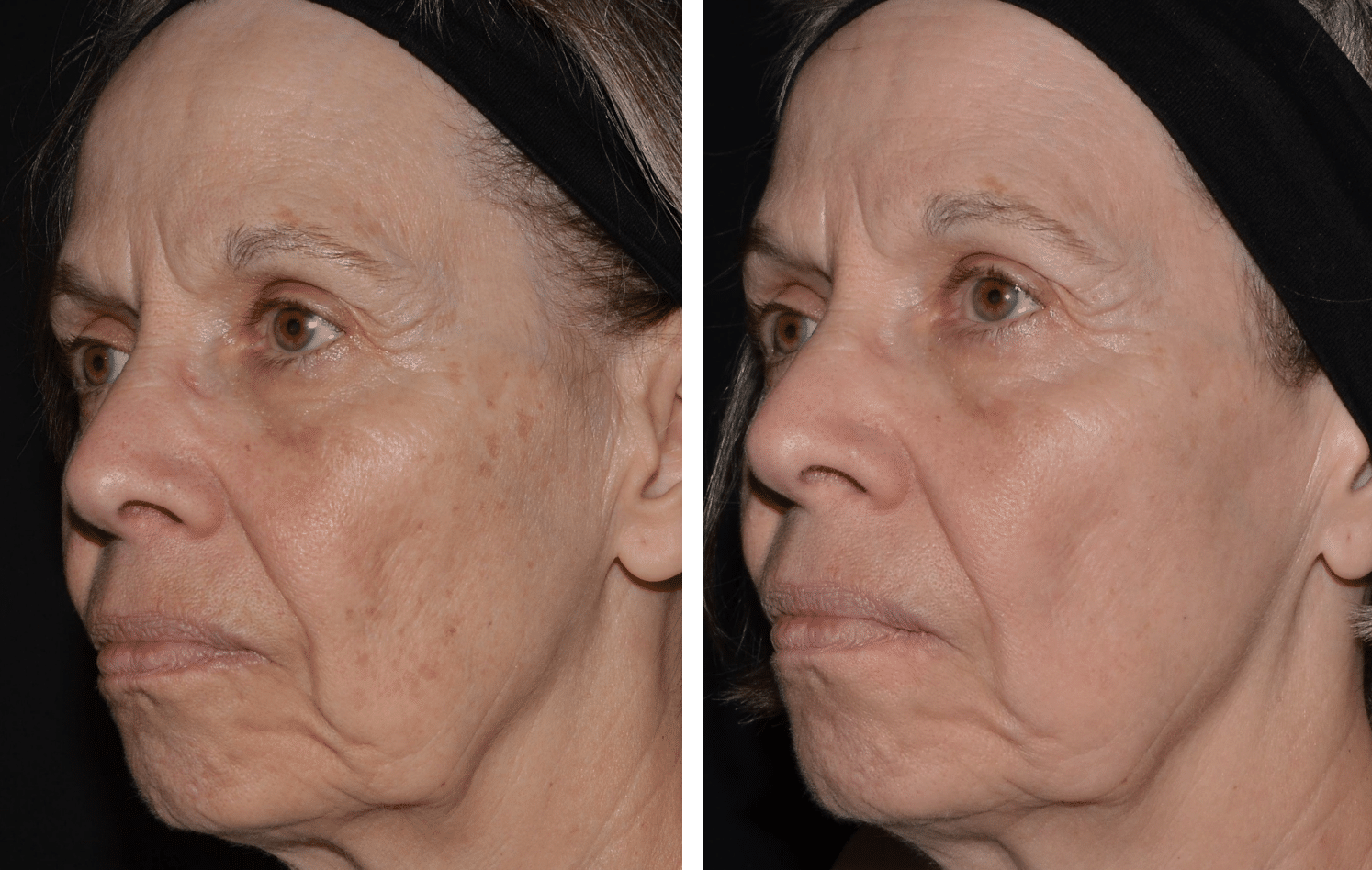 lasemd treatment for skin tightening before and after
