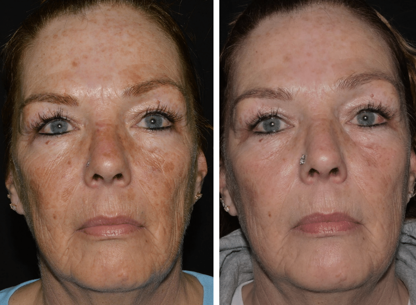lasemd results on a female patient from NJ