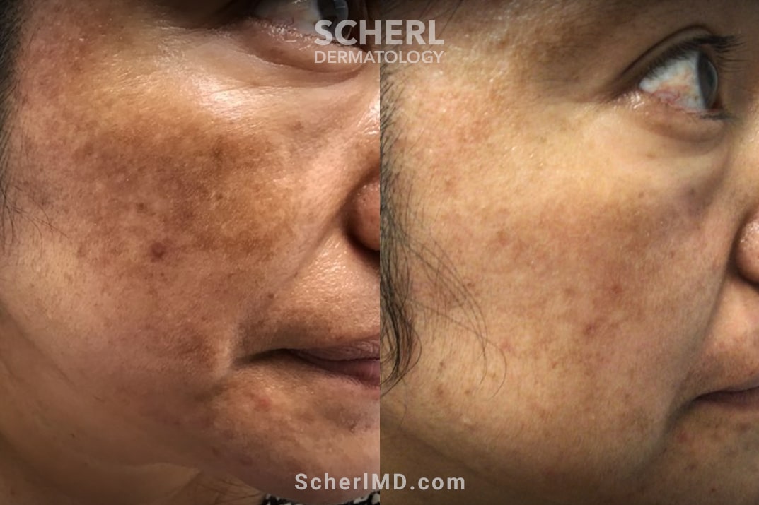 scherl dermatology melasma treatment before and after cheek englewood cliffs nj