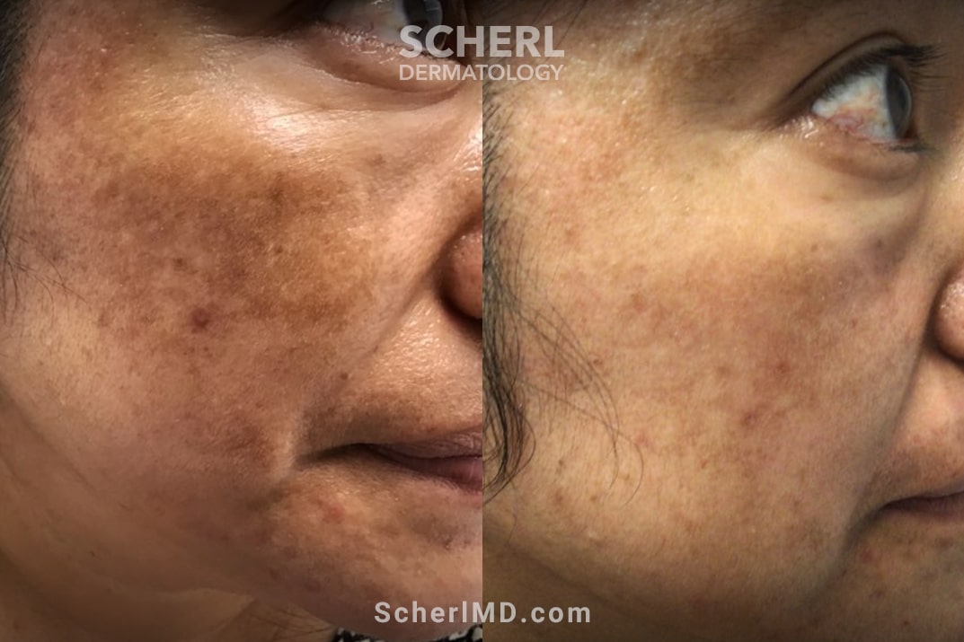 melasma treatment results