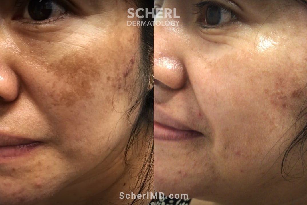 melasma treatment before and after