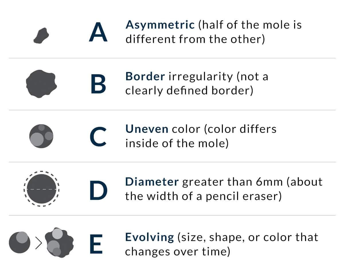types of moles