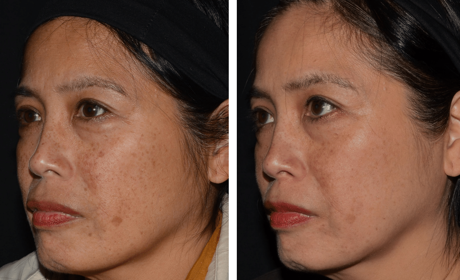 lasemd treatment before and after