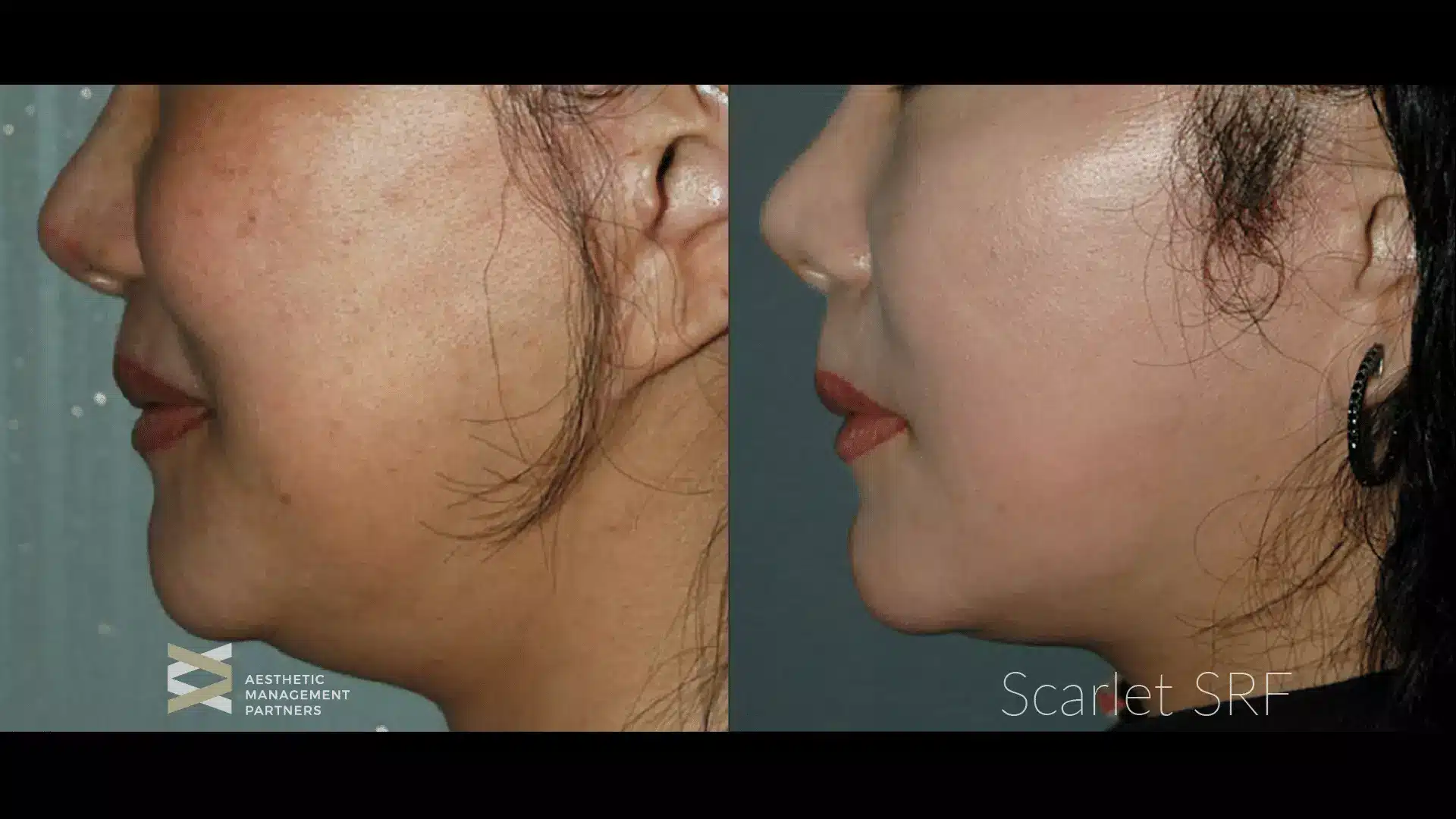 RF treatment to improve skin texture before and after
